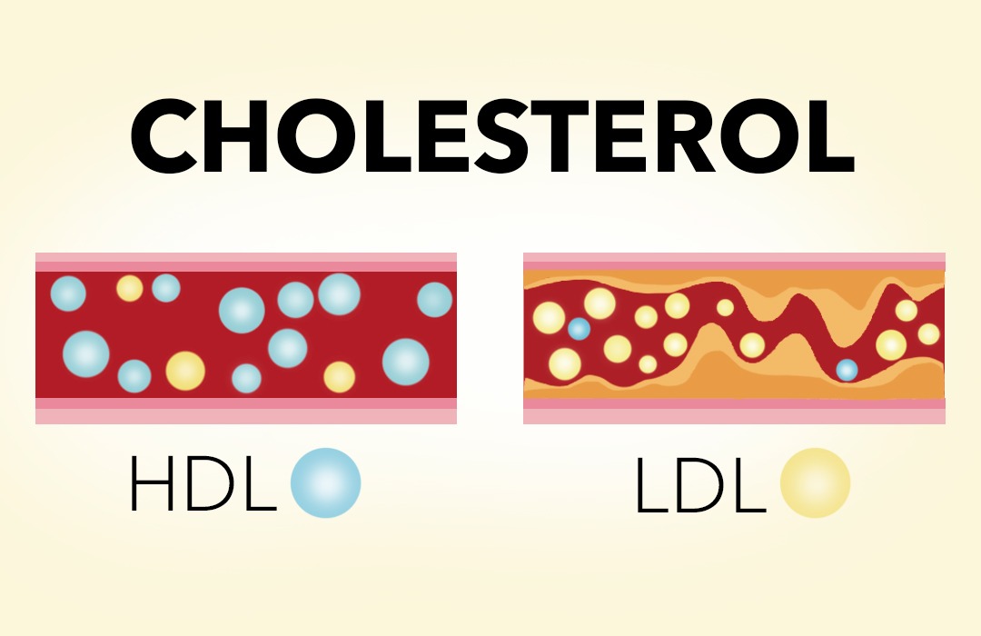 Dve vrsti holesterola